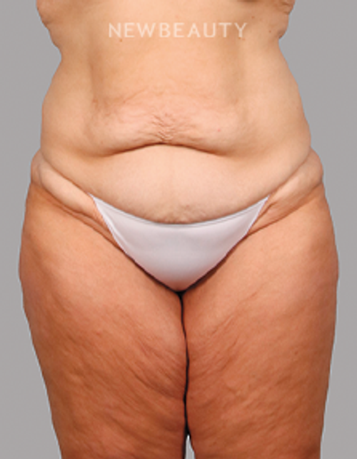 Dr. Carmen Kavali - Beautiful Transformation - 45242669 - Before