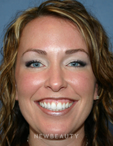 Dr. Kelly Bomer, Injections/Liquid Lift - After