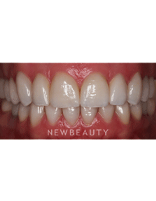 Dr. Neal Patel Smile Makeover - After