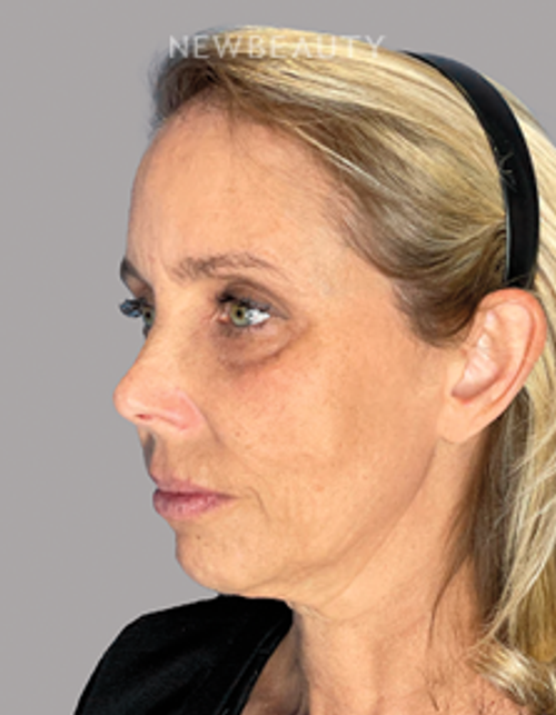 Dr. Philippe A. Capraro - Bridal Rejuvenation - 44179957 - Before