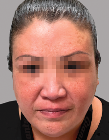 Dr. Anna Chacon - Melasma - 34280278 - Before