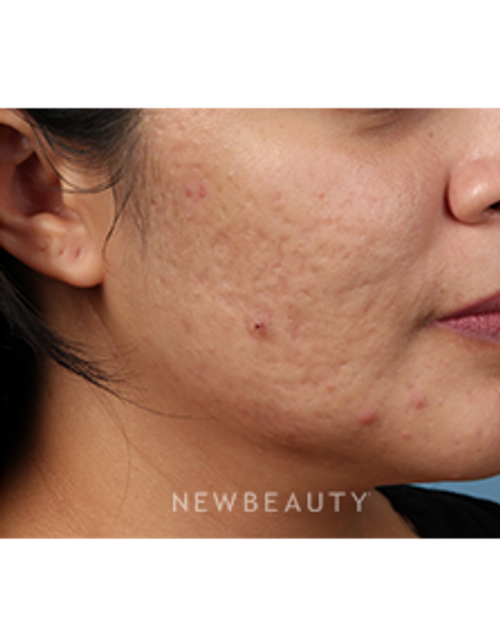 Dr. Kathleen Behr - PicoSure - After