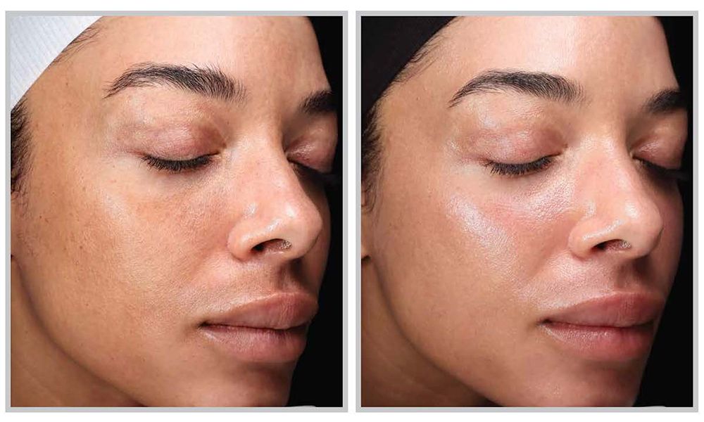 One week after a single HALO TRIBRID treatment.