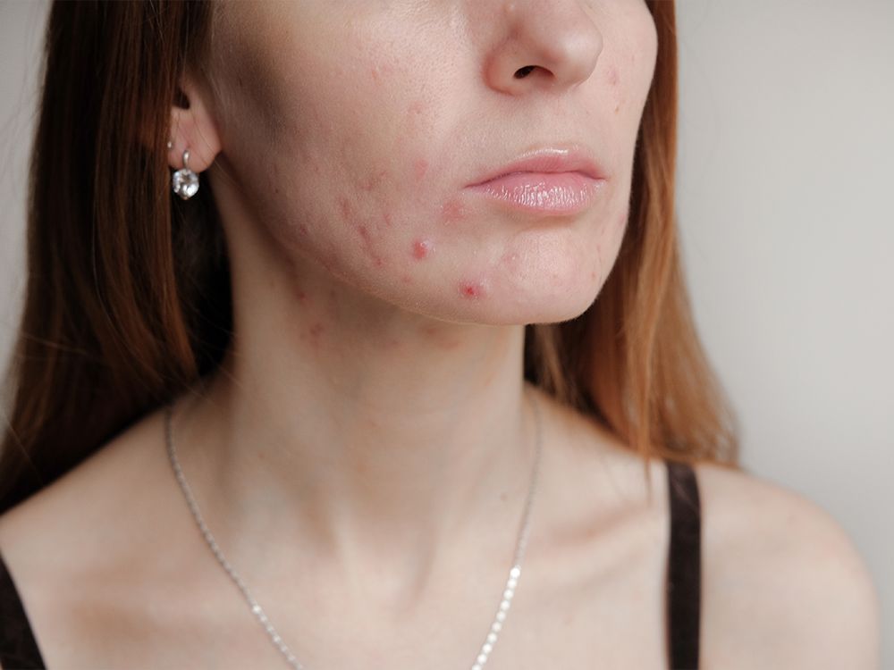 A New Cream Featuring Both Tretinoin and Benzoyl Peroxide Is Here