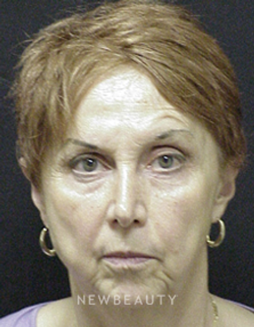 Dr. Mokhtar Asaadi Eyelid Lift, Facelift, Necklift - Before