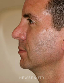 Dr. Lee Ann M. Klausner - Revision Rhinoplasty - Before
