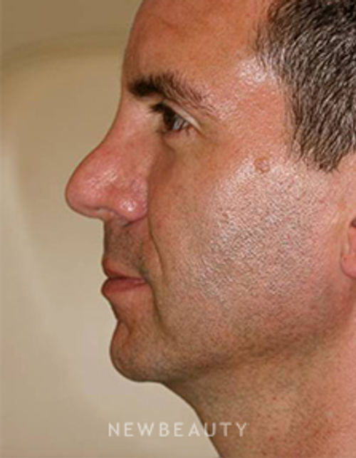 Dr. Lee Ann M. Klausner - Revision Rhinoplasty - Before