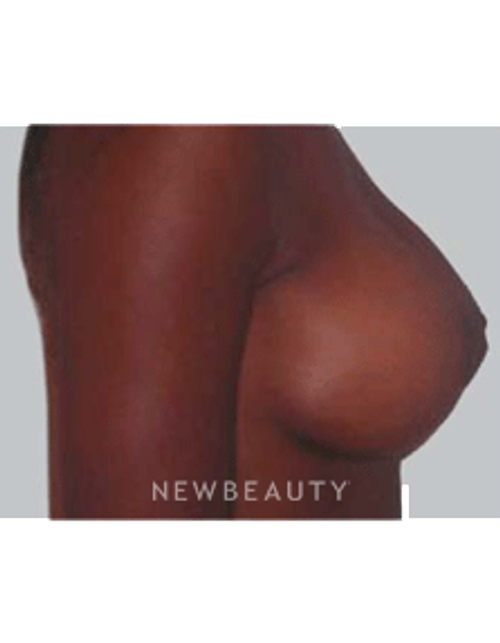 Dr. Michael Horn Breast Lift - After