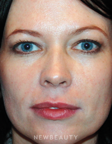 Dr. Kelly Bomer Blepharoplasty - Before