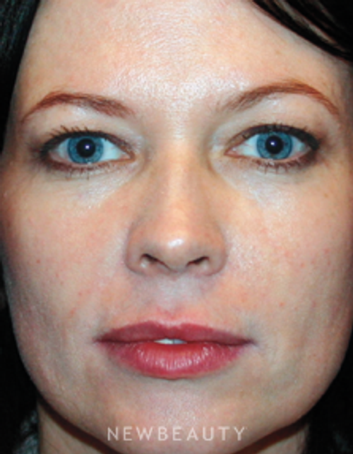 Dr. Kelly Bomer Blepharoplasty - Before