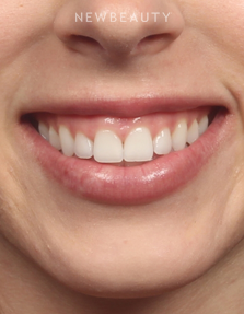 Dr. Kelly Bomer - Botox - Before