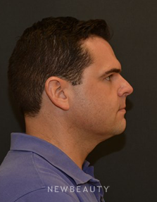 Dr. Janet Allenby - Kybella - After