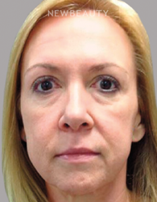 Dr. Janine Hopkins - “Liquid Facelift” - Before