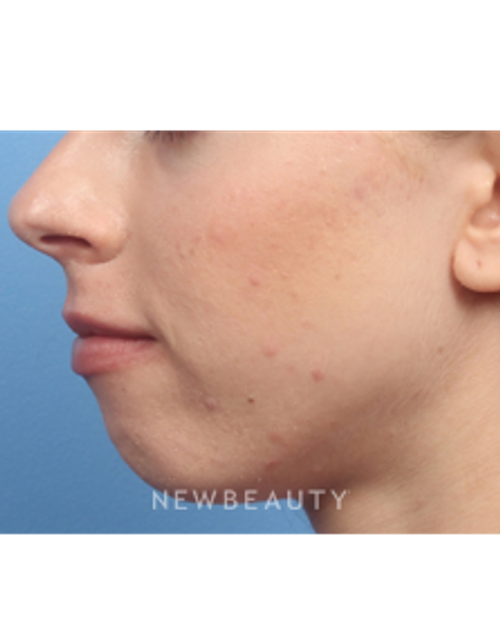 Dr. Kelly Bomer - Radiesse - Before