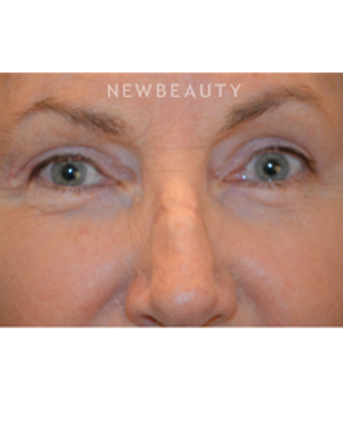 Dr. B. Aviva Preminger - Restoring a Natural Look - After