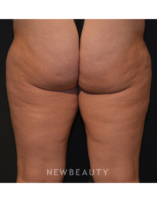 Dr. Janet Allenby - Body Sculpting - Before