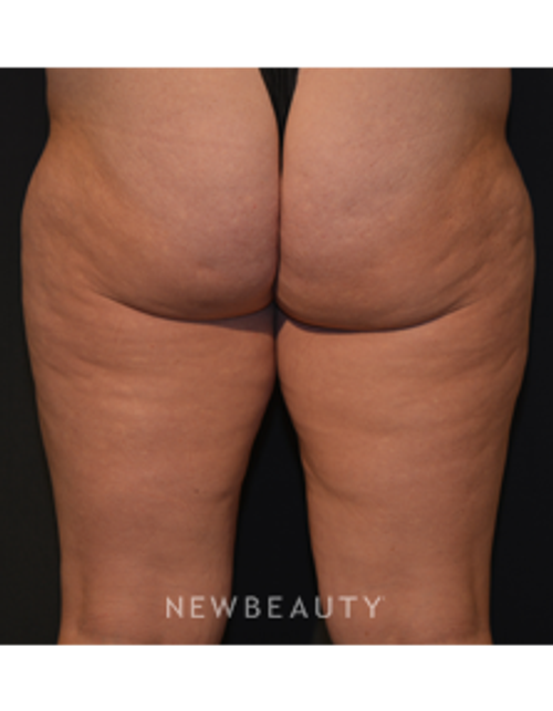 Dr. Janet Allenby - Body Sculpting - Before