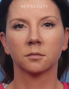 Dr. Kelly Bomer - Liquid Facelift - After