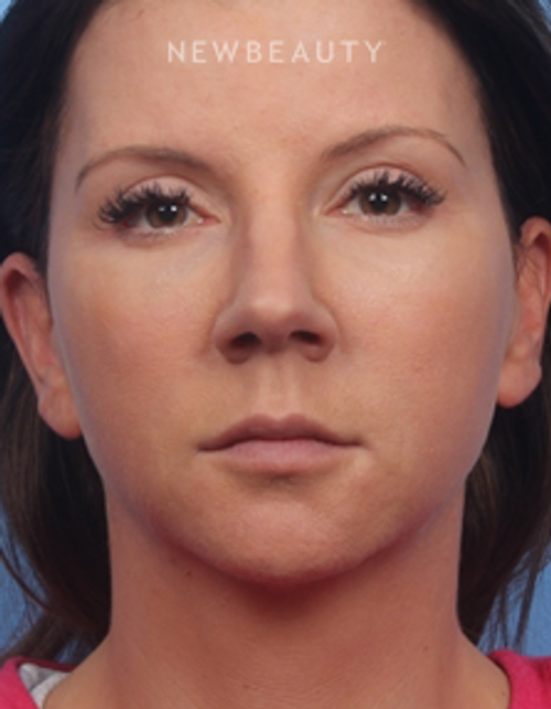 Dr. Kelly Bomer - Liquid Facelift - After