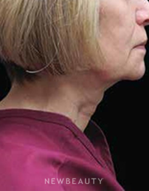 Dr. Elie Levine- Facelift - Before