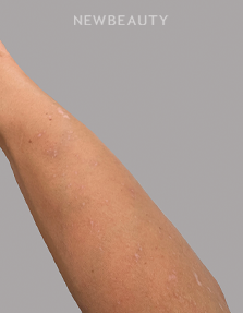 Dr. Anna Chacon – Skin Treatment - 34277007 - After