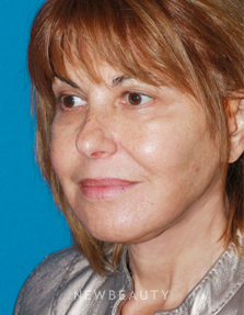Dr. Konstantin Vasyukevich, Traditional Facelift - After