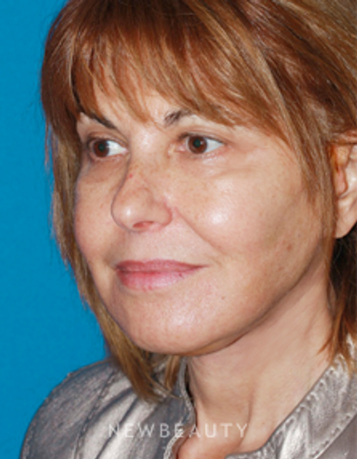 Dr. Konstantin Vasyukevich, Traditional Facelift - After