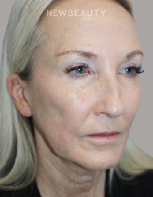 Dr. Sanjay Grover - Facelift - 49726292 - Before