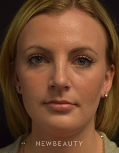 Dr. Jeffrey B. Wise - Rhinoplasty - After