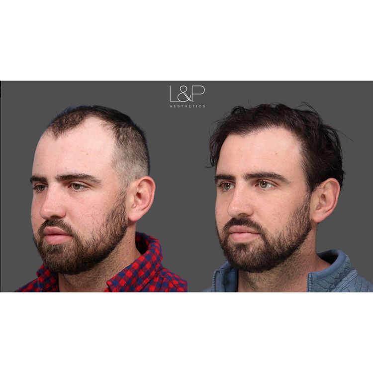 Palo Alto, CA facial plastic surgeons David Lieberman, MD and Sachin S. Parikh, MD