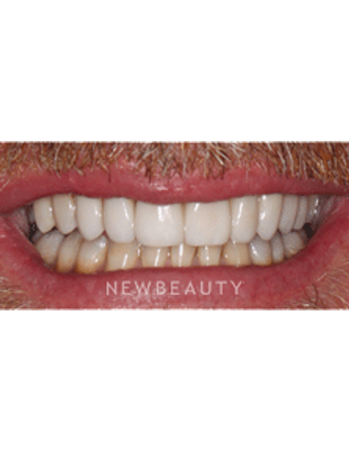 Dr. Neal Patel Smile Makeover - After