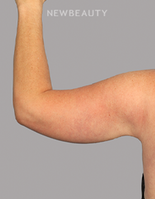 Dr. Mahabir - Arm Lift - 20638033 - After