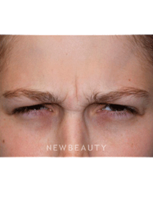 Dr. Marina Peredo Botox - Before