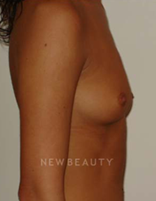 Dr. Michael Horn Silicone Breast Implants - Before