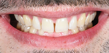 Dr. Husam Almunajed - Veneers & Gum Lift - 49692827 - Before