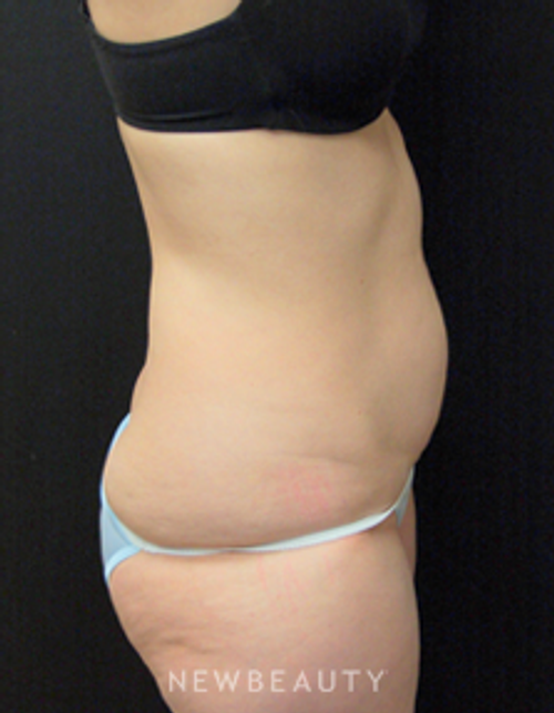 Dr. Mokhtar Asaadi Liposuction - Before