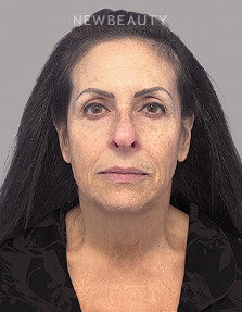 Dr. Dilip Madnani - Facelift - 45283915 - Before