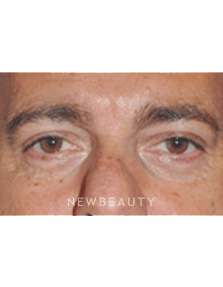 Dr. Lee Ann Klausner Blepharoplasty - After