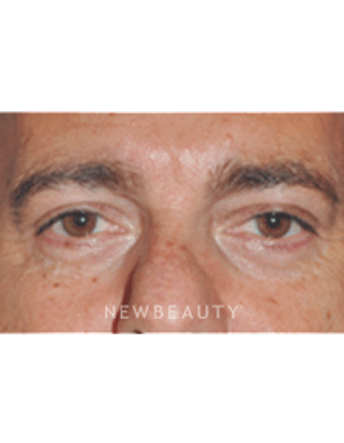Dr. Lee Ann Klausner Blepharoplasty - After