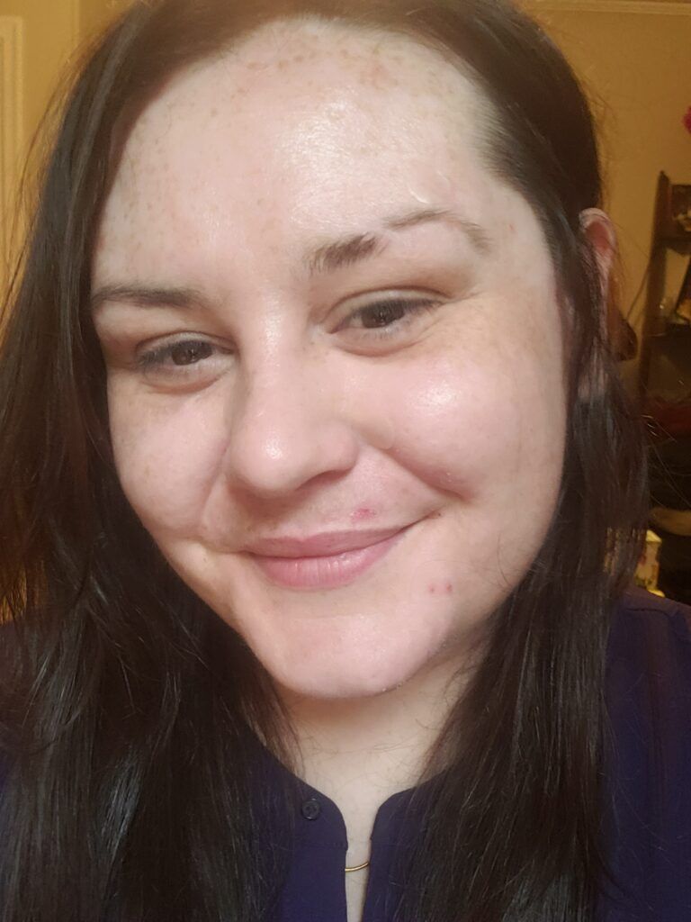 Rowan Lynam wearing Neutrogena Stubborn Acne Patch