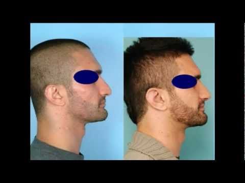 Dr. David Kim – Rhinoplasty – The Structural Approach To Rhinoplasty – Part 6