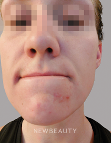 Dr. Anna Chacon – Acne – 34276962 - Before