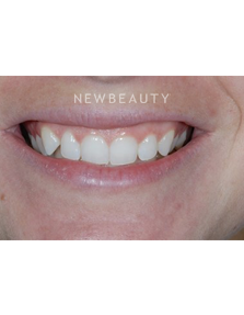 Dr. Guy M. Lewis - Smile Makeover - Before