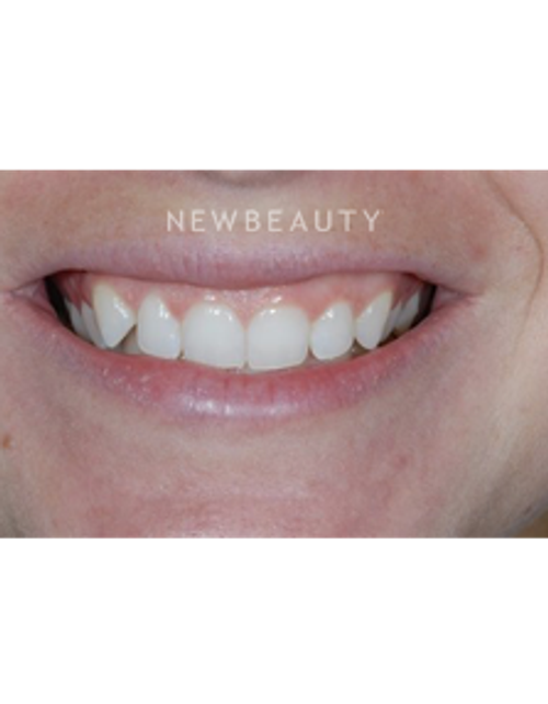 Dr. Guy M. Lewis - Smile Makeover - Before