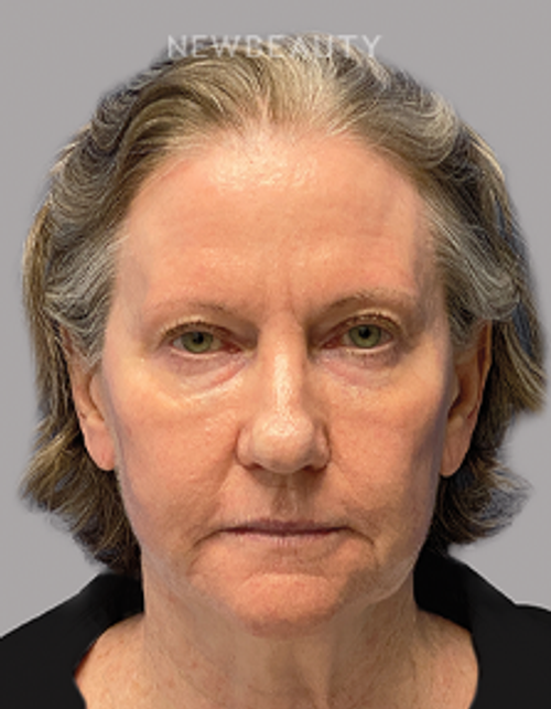 Dr. Paul Afrooz – Beautiful Transformation – 36269784 - Before