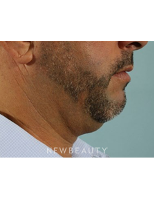 Dr. Marina Peredo - Kybella - Before