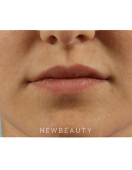 Dr. Marina Peredo Lip Augmentation - Before