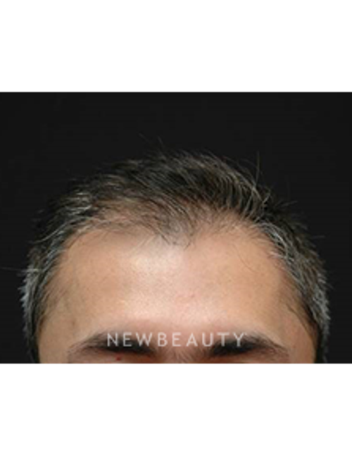 Dr. Jeffrey B. Wise - Hair Loss Treatment - Before