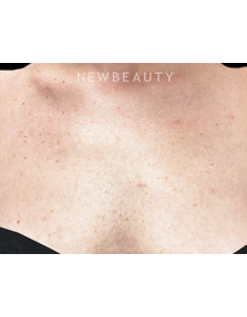 Dr. Julie Russak - Lasers - Before