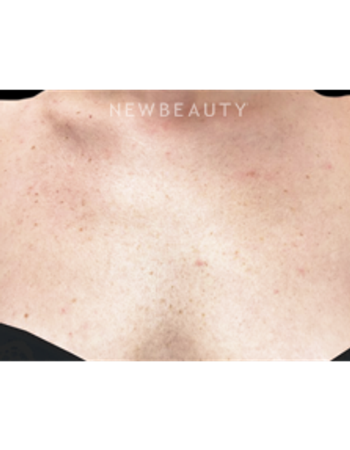 Dr. Julie Russak - Lasers - Before
